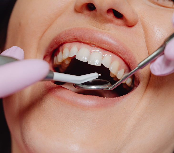 Estetik Diş Dolgusu image