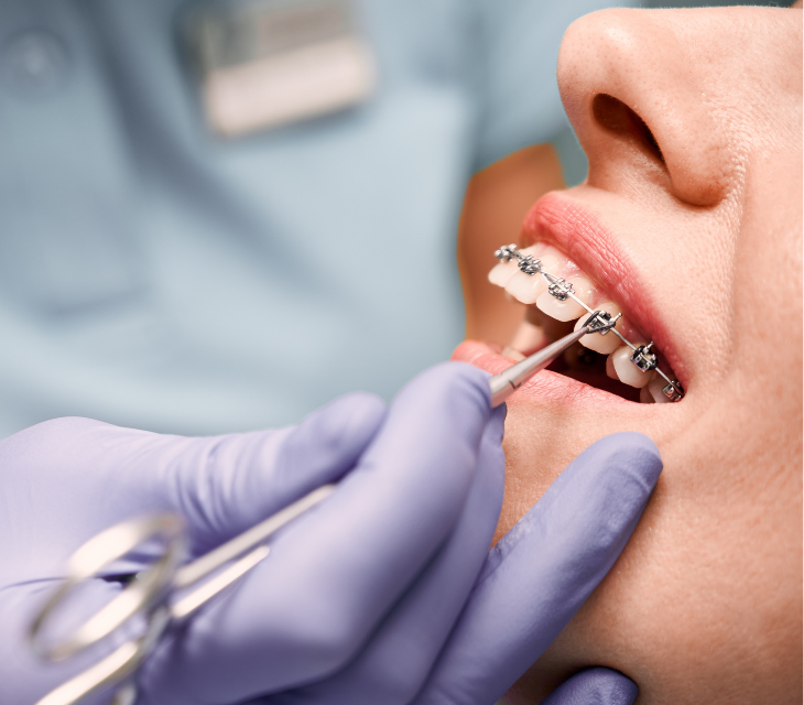 Ortodonti (Tel Tedavisi) image